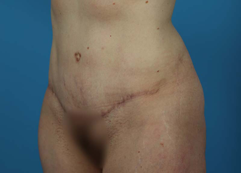 Abdominoplasty Before and After | Dr Evan W Beale