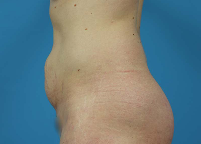 Abdominoplasty Before and After | Dr Evan W Beale