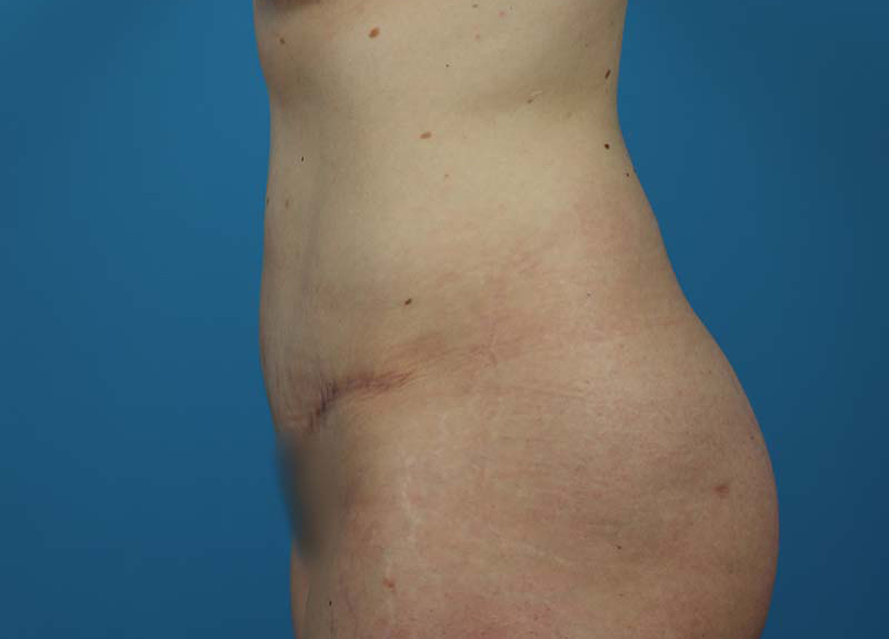 Abdominoplasty Before and After | Dr Evan W Beale