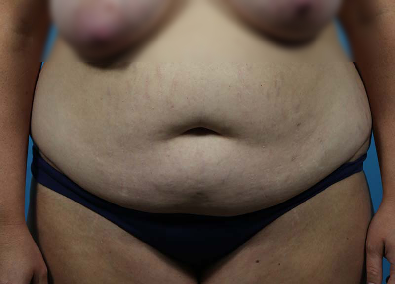 Abdominoplasty Before and After | Dr Evan W Beale
