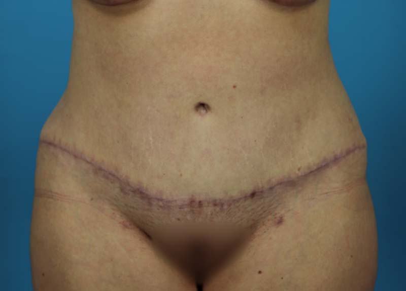 Abdominoplasty Before and After | Dr Evan W Beale