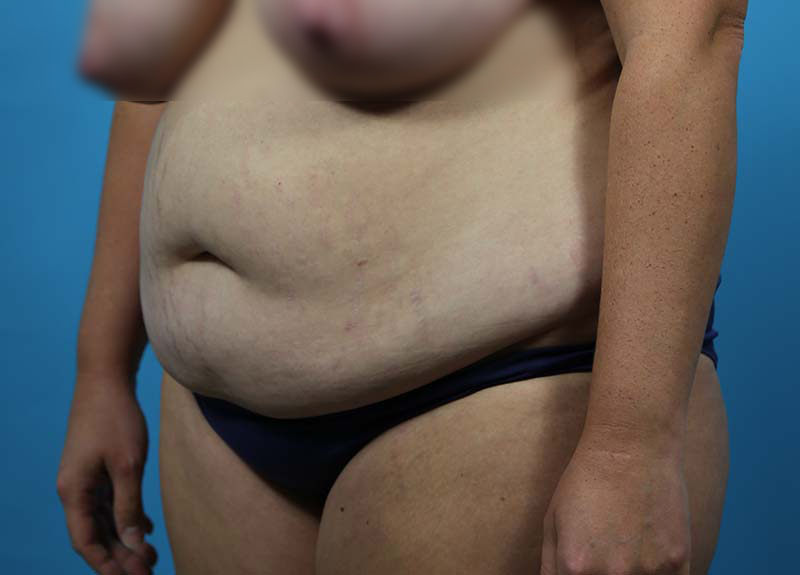 Abdominoplasty Before and After | Dr Evan W Beale