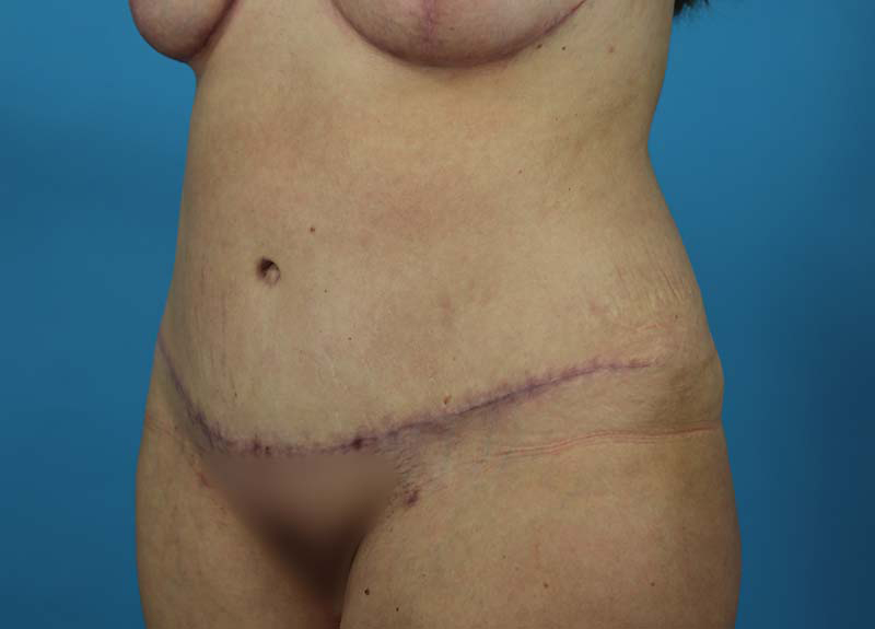 Abdominoplasty Before and After | Dr Evan W Beale
