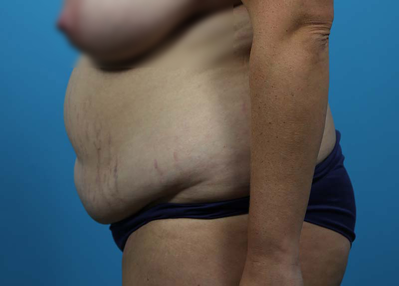 Abdominoplasty Before and After | Dr Evan W Beale