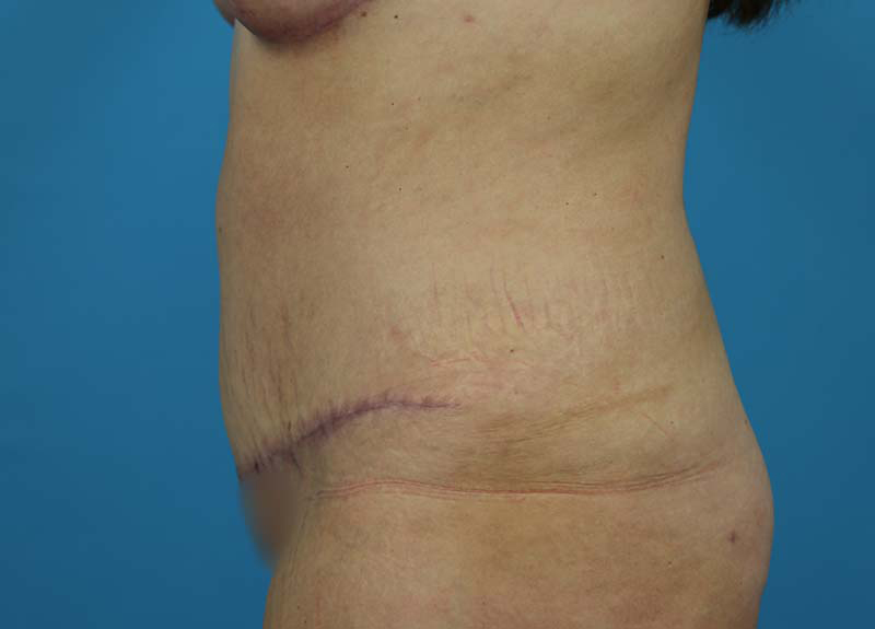 Abdominoplasty Before and After | Dr Evan W Beale