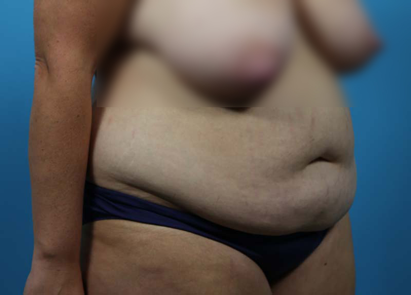Abdominoplasty Before and After | Dr Evan W Beale