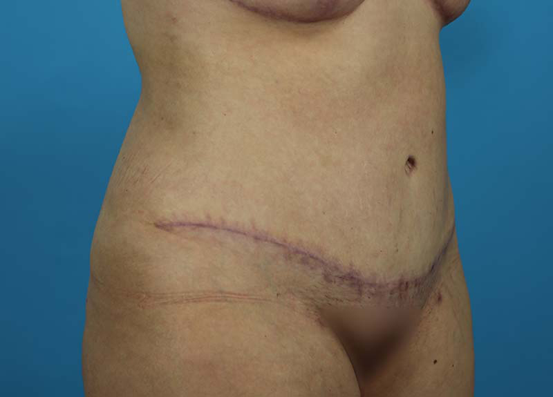 Abdominoplasty Before and After | Dr Evan W Beale