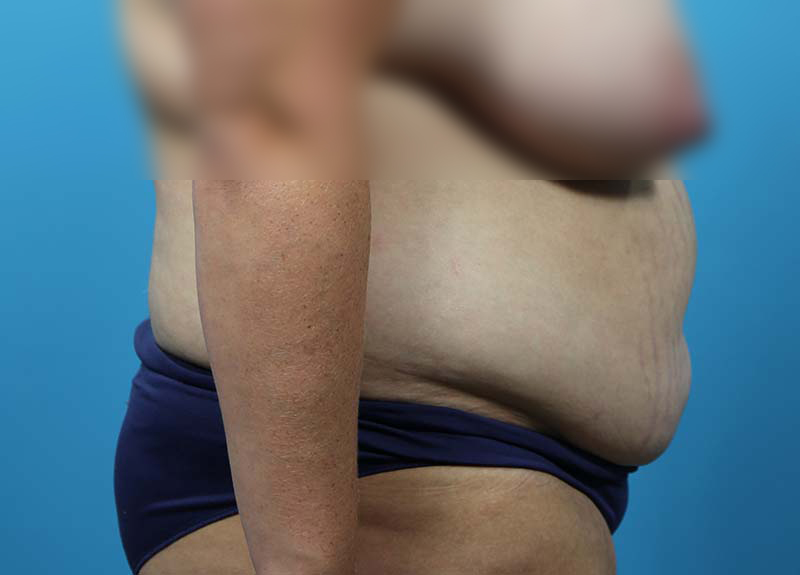 Abdominoplasty Before and After | Dr Evan W Beale