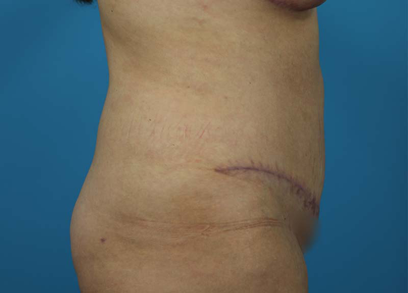 Abdominoplasty Before and After | Dr Evan W Beale