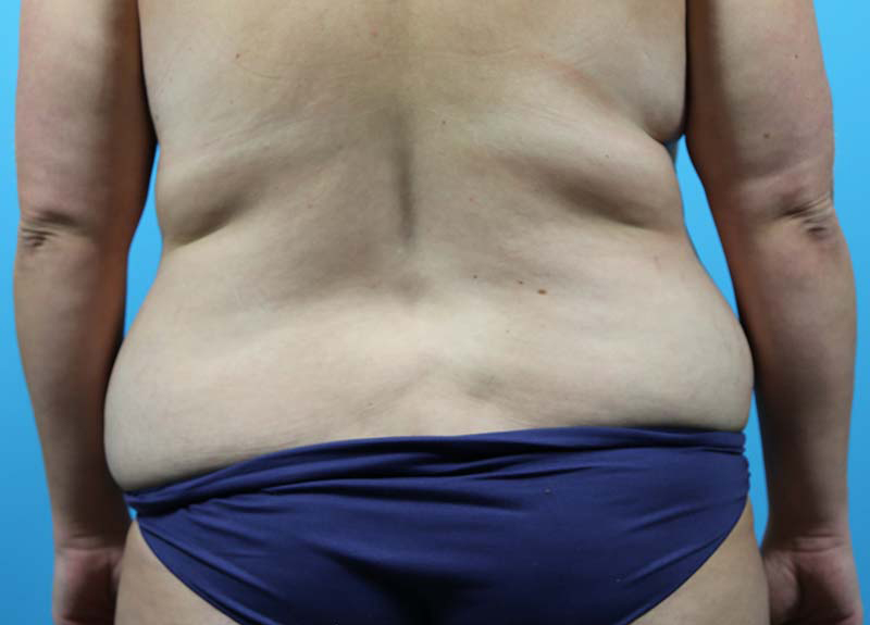 Abdominoplasty Before and After | Dr Evan W Beale