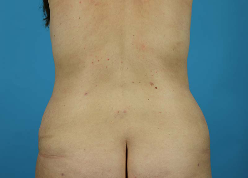 Abdominoplasty Before and After | Dr Evan W Beale