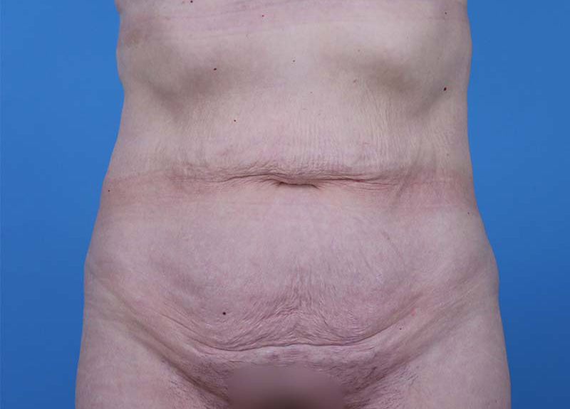 Abdominoplasty Before and After | Dr Evan W Beale