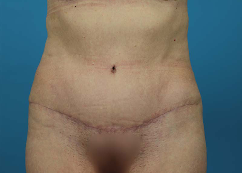 Abdominoplasty Before and After | Dr Evan W Beale