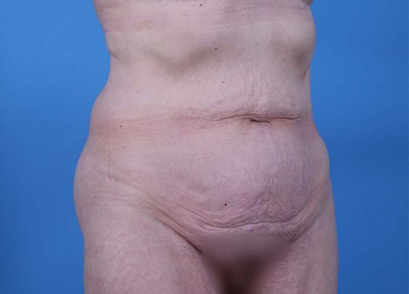 Abdominoplasty Before and After | Dr Evan W Beale