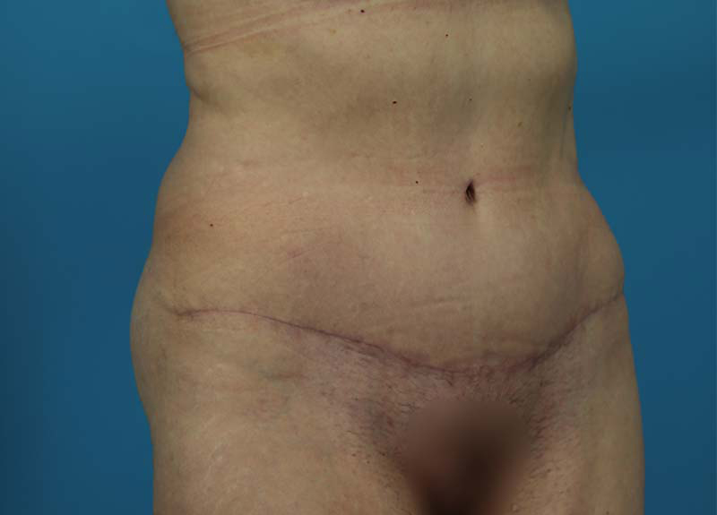 Abdominoplasty Before and After | Dr Evan W Beale