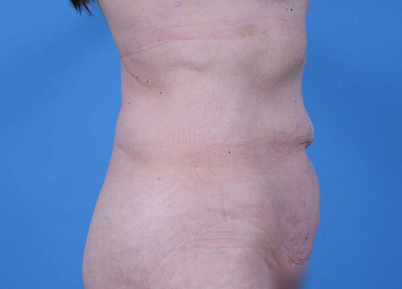 Abdominoplasty Before and After | Dr Evan W Beale