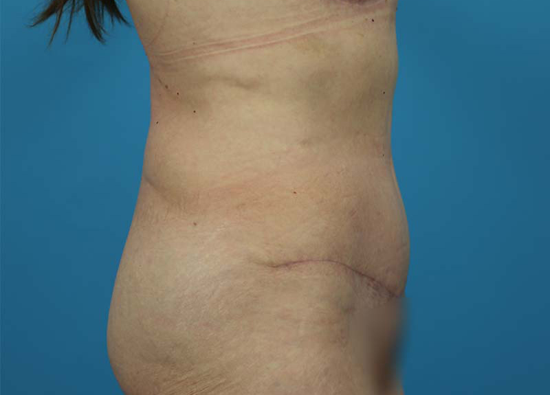 Abdominoplasty Before and After | Dr Evan W Beale
