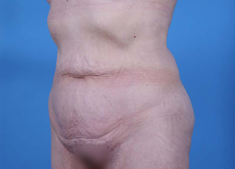 Abdominoplasty Before and After | Dr Evan W Beale