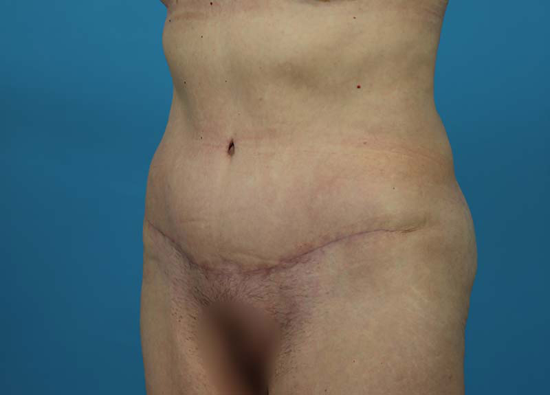 Abdominoplasty Before and After | Dr Evan W Beale