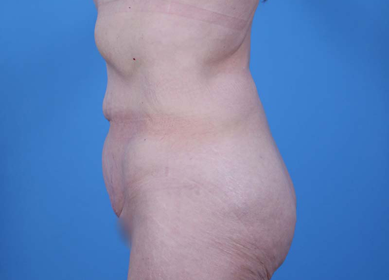 Abdominoplasty Before and After | Dr Evan W Beale