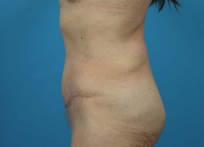 Abdominoplasty Before and After | Dr Evan W Beale