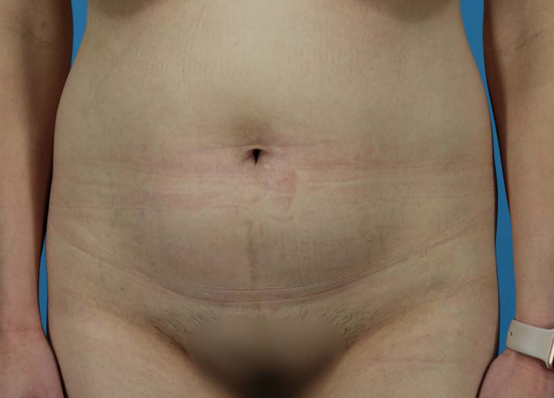 Abdominoplasty Before and After | Dr Evan W Beale