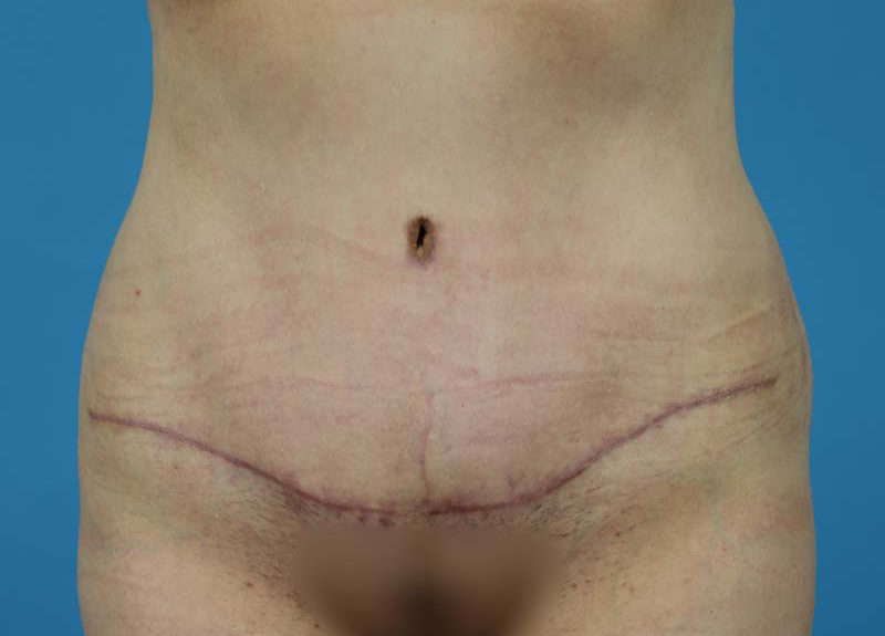 Abdominoplasty Before and After | Dr Evan W Beale