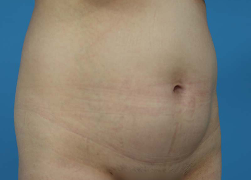 Abdominoplasty Before and After | Dr Evan W Beale