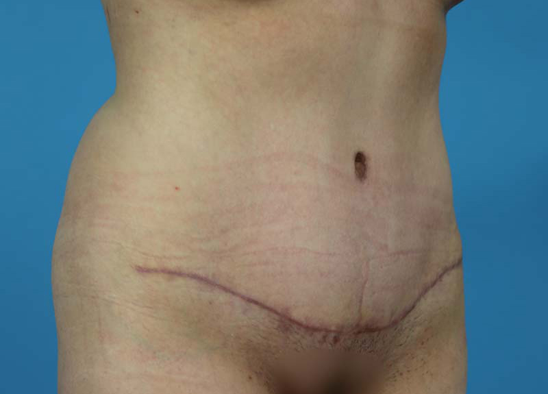 Abdominoplasty Before and After | Dr Evan W Beale