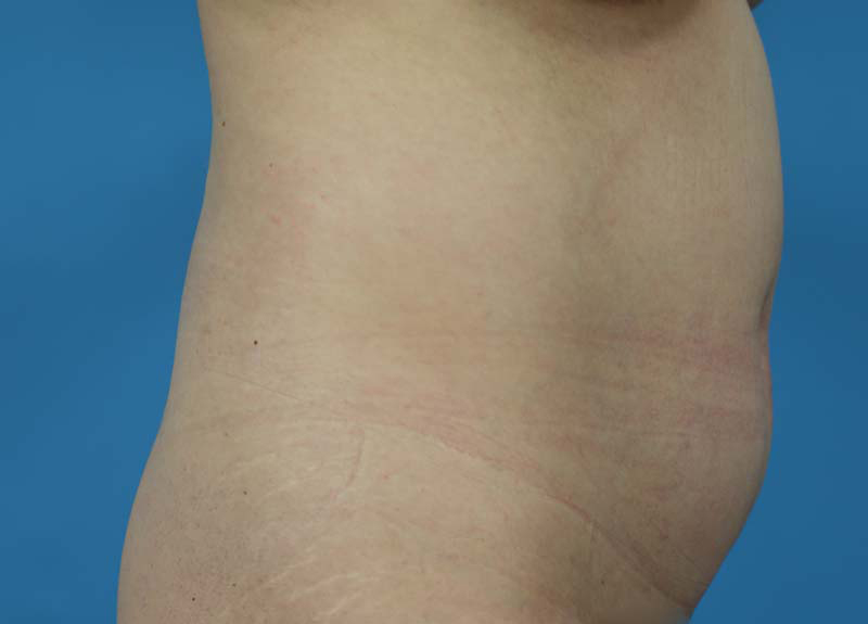 Abdominoplasty Before and After | Dr Evan W Beale