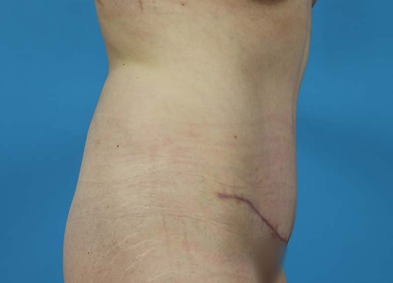 Abdominoplasty Before and After | Dr Evan W Beale