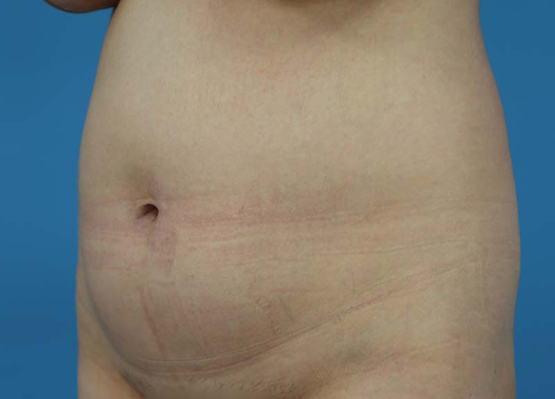 Abdominoplasty Before and After | Dr Evan W Beale