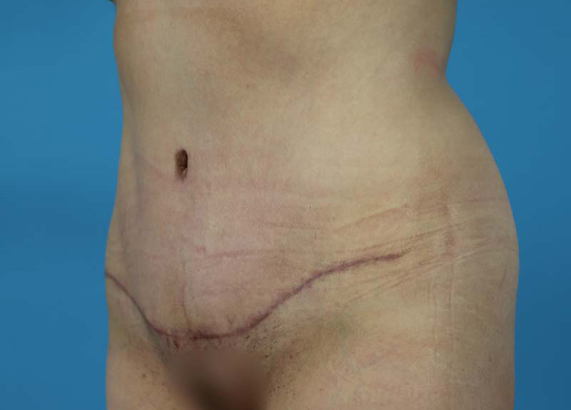Abdominoplasty Before and After | Dr Evan W Beale