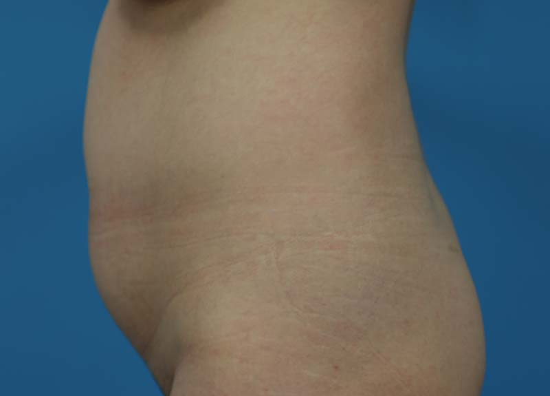 Abdominoplasty Before and After | Dr Evan W Beale