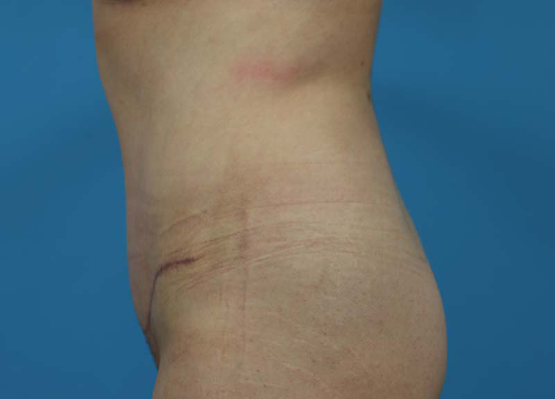 Abdominoplasty Before and After | Dr Evan W Beale