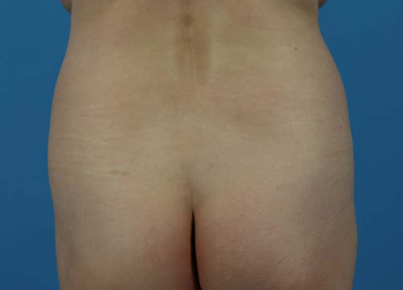 Abdominoplasty Before and After | Dr Evan W Beale