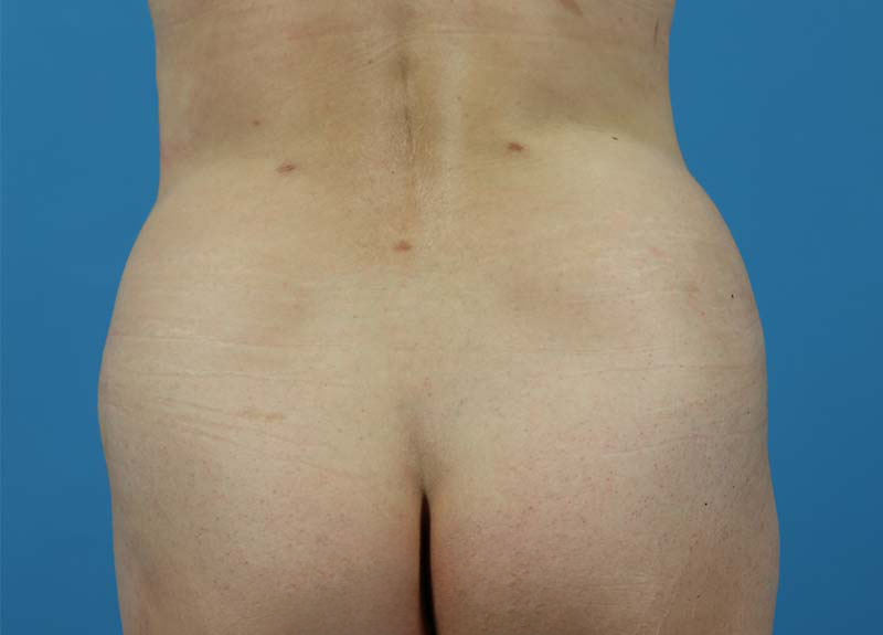 Abdominoplasty Before and After | Dr Evan W Beale