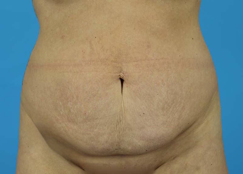 Abdominoplasty Before and After | Dr Evan W Beale