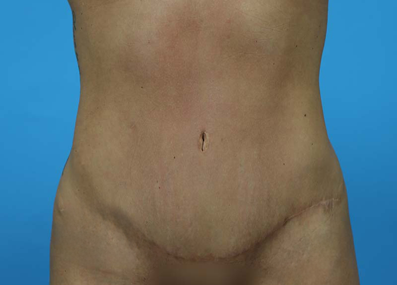 Abdominoplasty Before and After | Dr Evan W Beale