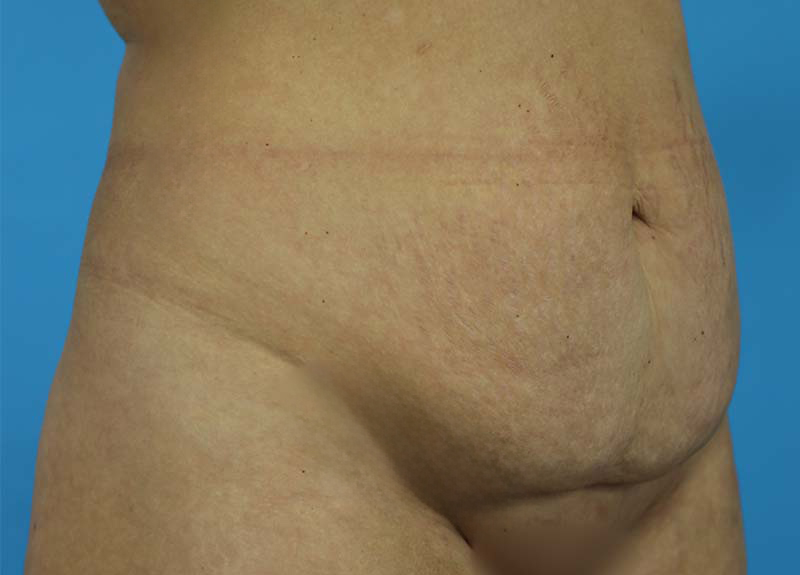 Abdominoplasty Before and After | Dr Evan W Beale