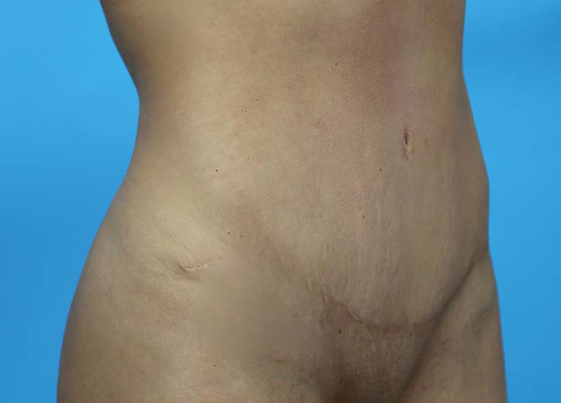 Abdominoplasty Before and After | Dr Evan W Beale