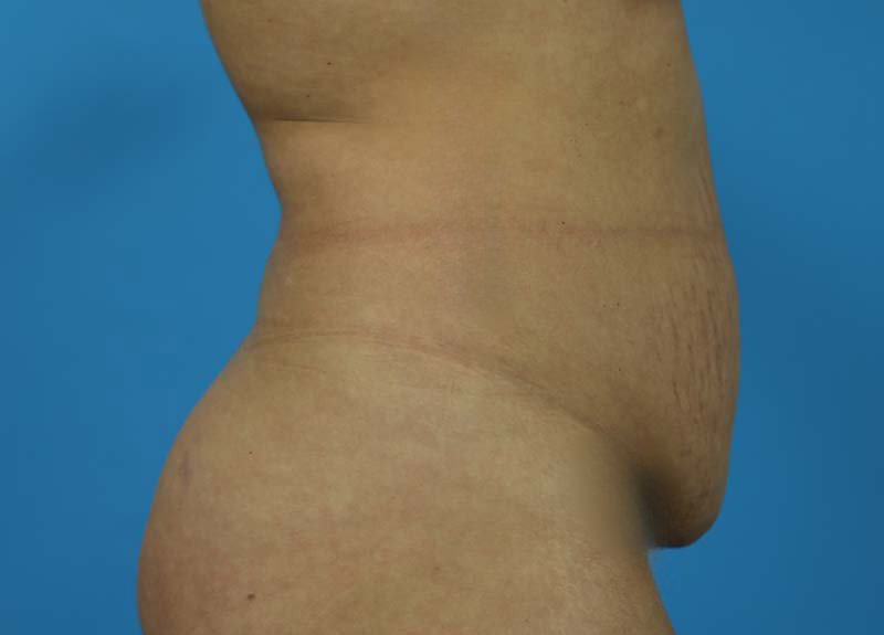 Abdominoplasty Before and After | Dr Evan W Beale