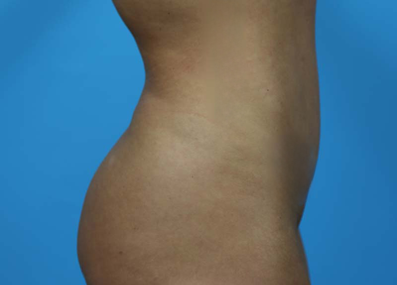 Abdominoplasty Before and After | Dr Evan W Beale