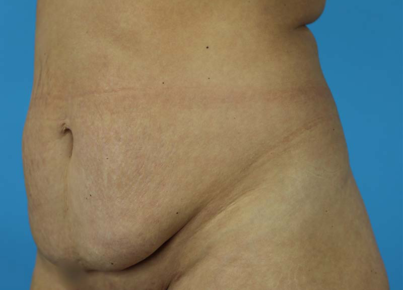 Abdominoplasty Before and After | Dr Evan W Beale