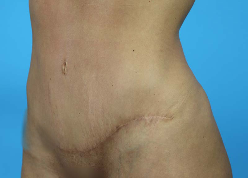 Abdominoplasty Before and After | Dr Evan W Beale
