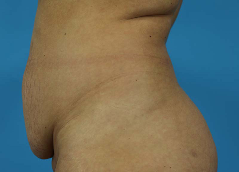 Abdominoplasty Before and After | Dr Evan W Beale