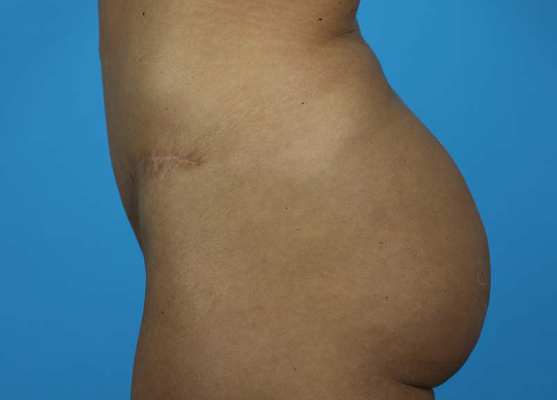 Abdominoplasty Before and After | Dr Evan W Beale