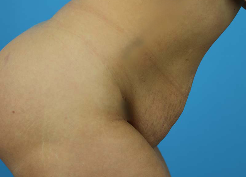 Abdominoplasty Before and After | Dr Evan W Beale