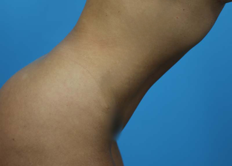 Abdominoplasty Before and After | Dr Evan W Beale