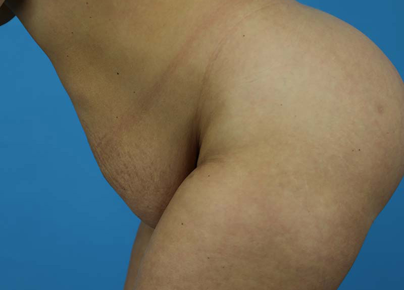 Abdominoplasty Before and After | Dr Evan W Beale